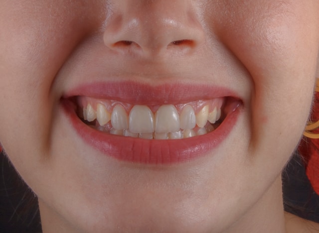 Young woman smiling broadly showing straight teeth